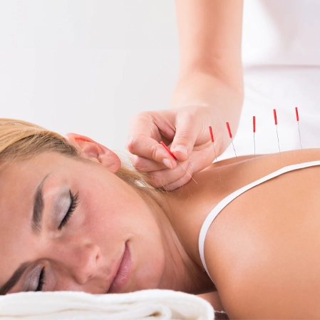 Chiropractic Frederick CO Woman Receiving Acupuncture