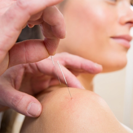 Chiropractic Frederick CO Woman Receiving Dry Needling