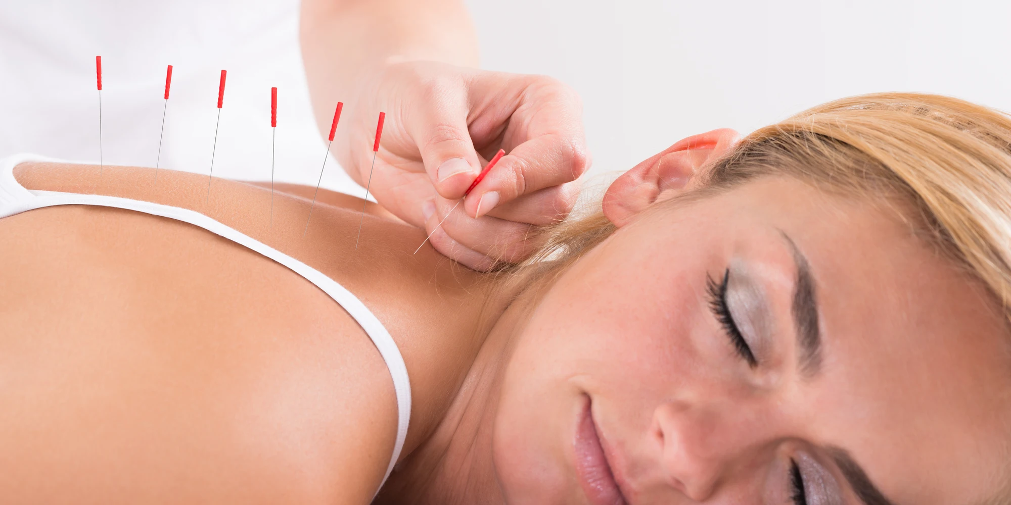 Chiropractic Erie CO Woman Receiving Acupuncture Treatment